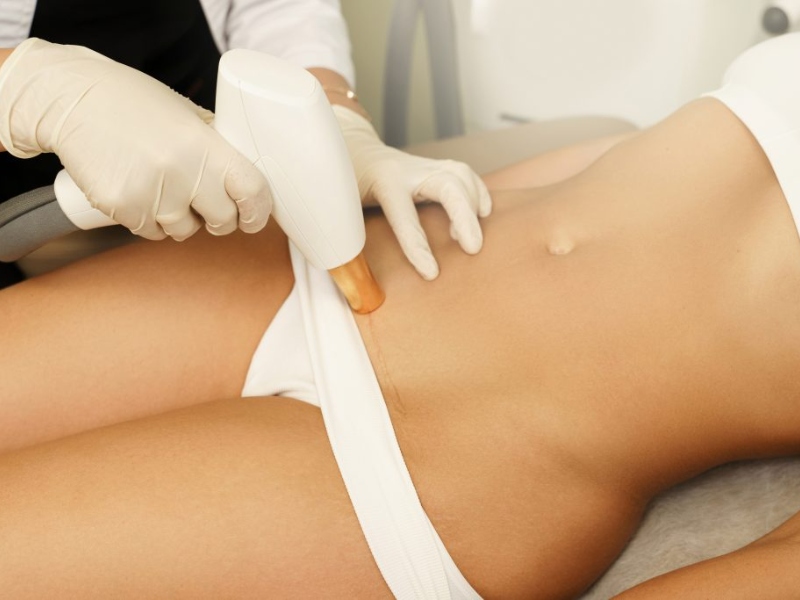 Triệt lông vùng kín bằng laser - 2