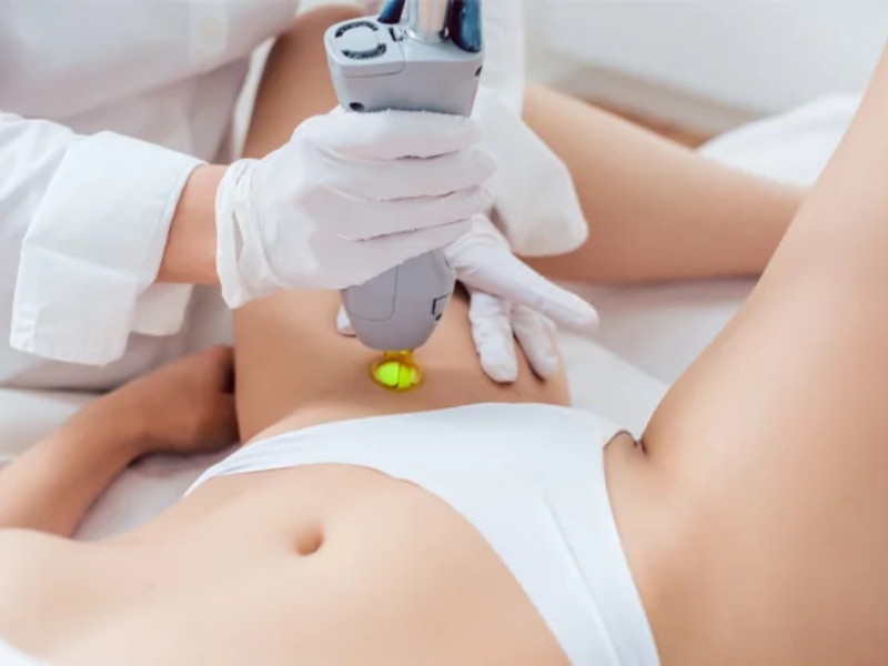 Triệt lông vùng kín bằng laser - 3