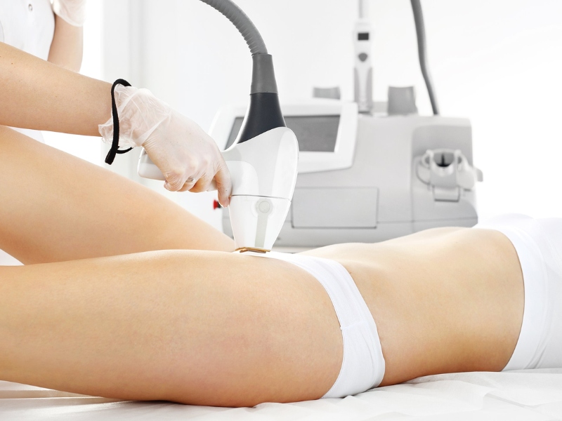 Triệt lông vùng kín bằng laser - 4