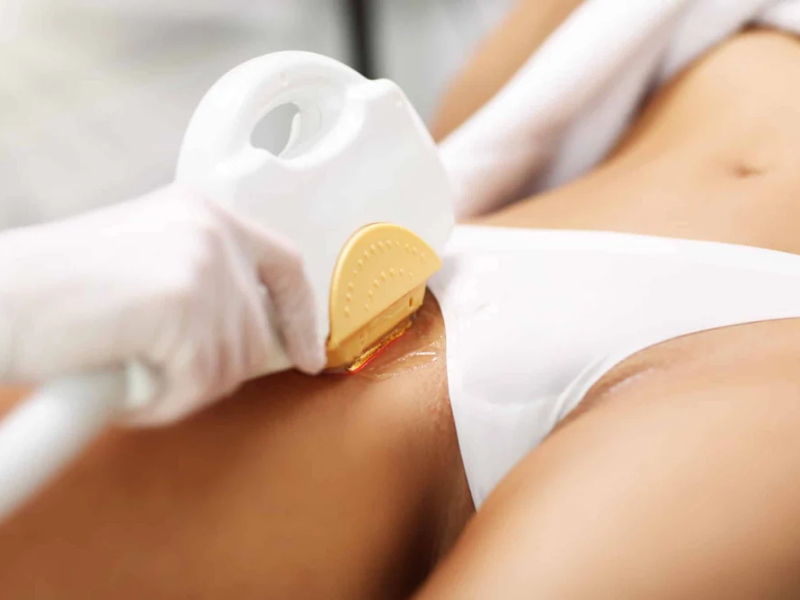 Triệt lông vùng kín bằng laser - 9
