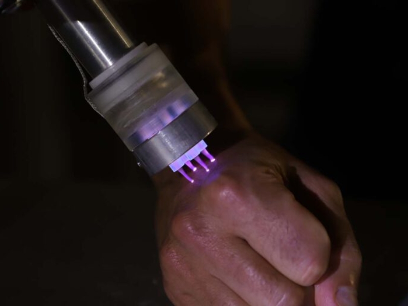 Điều trị dày sừng ánh nắng bằng plasma - 5