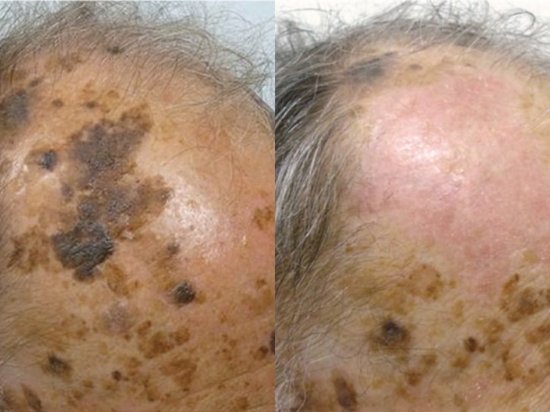 Điều trị dày sừng ánh nắng bằng plasma - 7